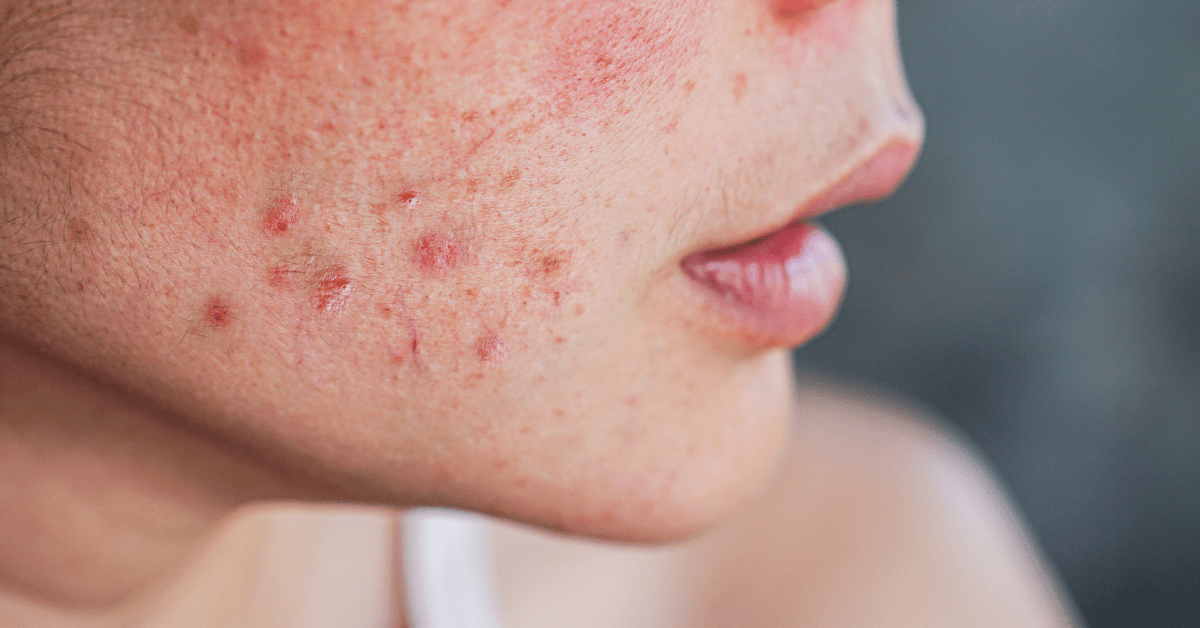 Face of a girl with acne.