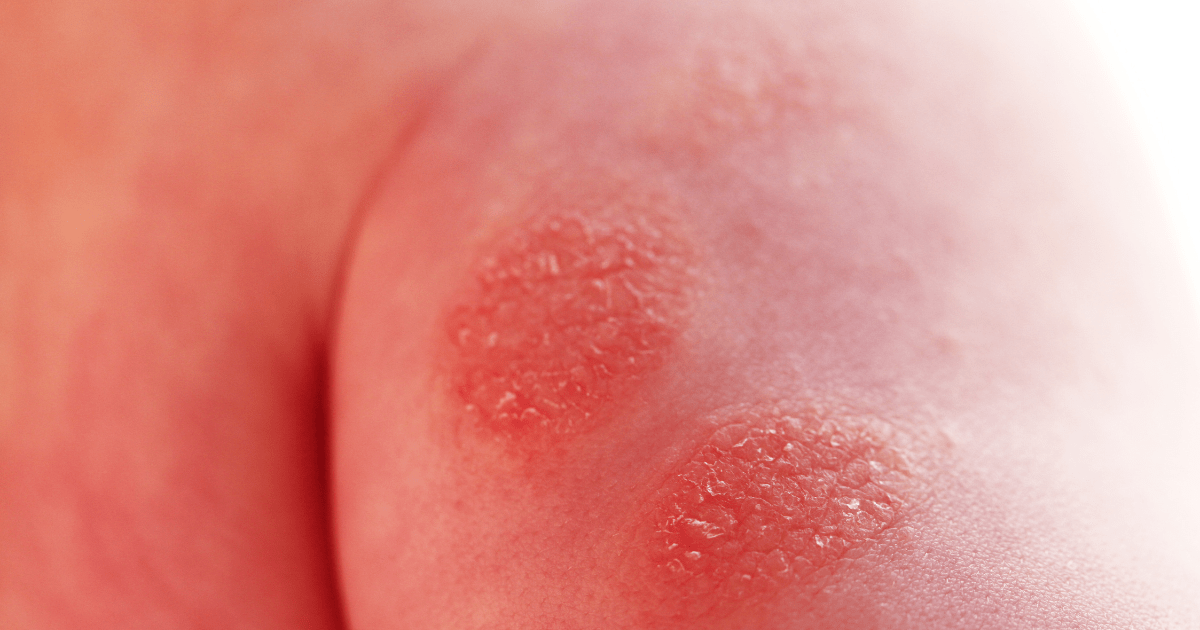 The picture shows part of the body with Nummular Eczema