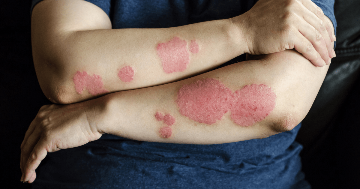 The image shows a man with Psoriasis on his arms