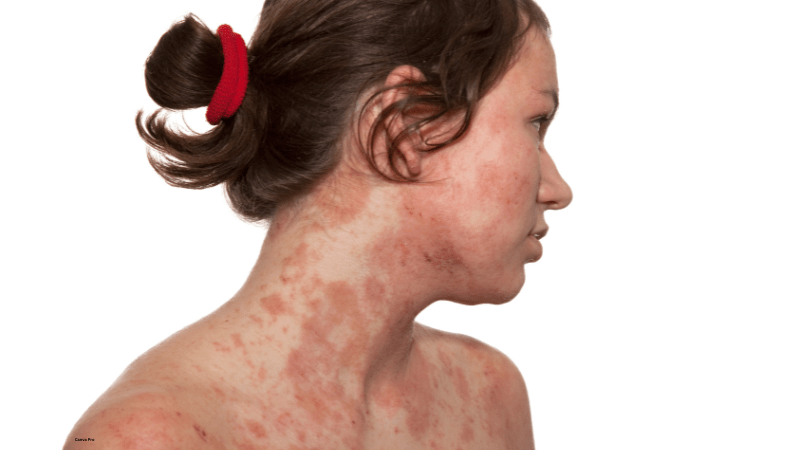 woman with eczema