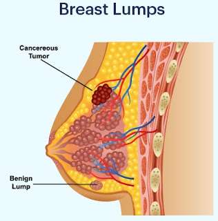 Breast Lumps