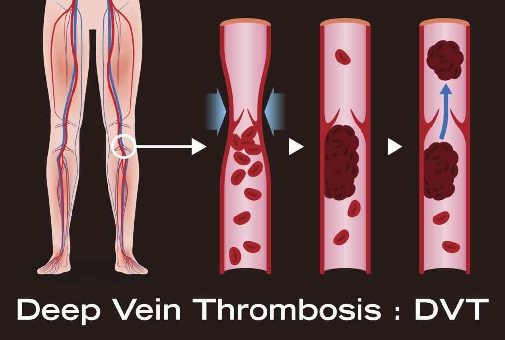 Deep Vein Thrombosis