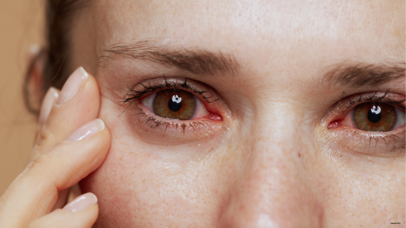 Dry eyes